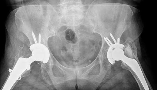 hip replacement lawsuit