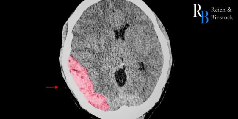 types of traumatic brain injuries