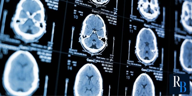 effects of traumatic brain injuries