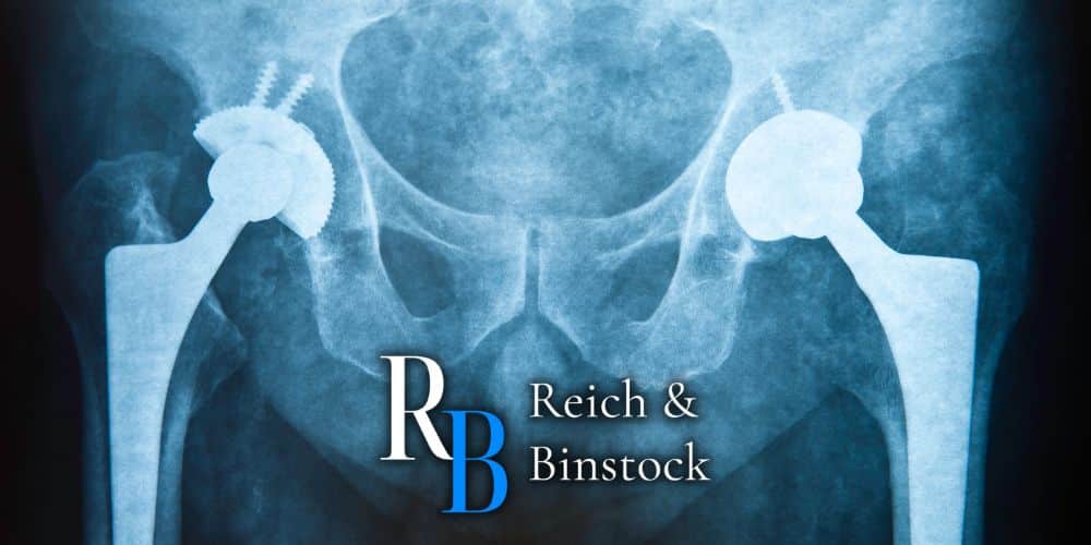 hip replacement lawsuit