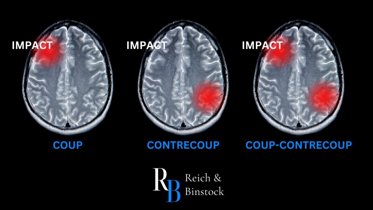 what is a coup contrecoup brain injury