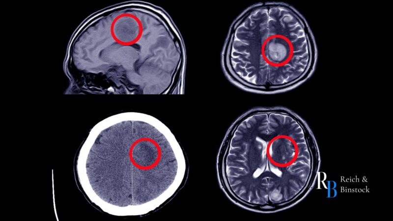 brain bleed symptoms