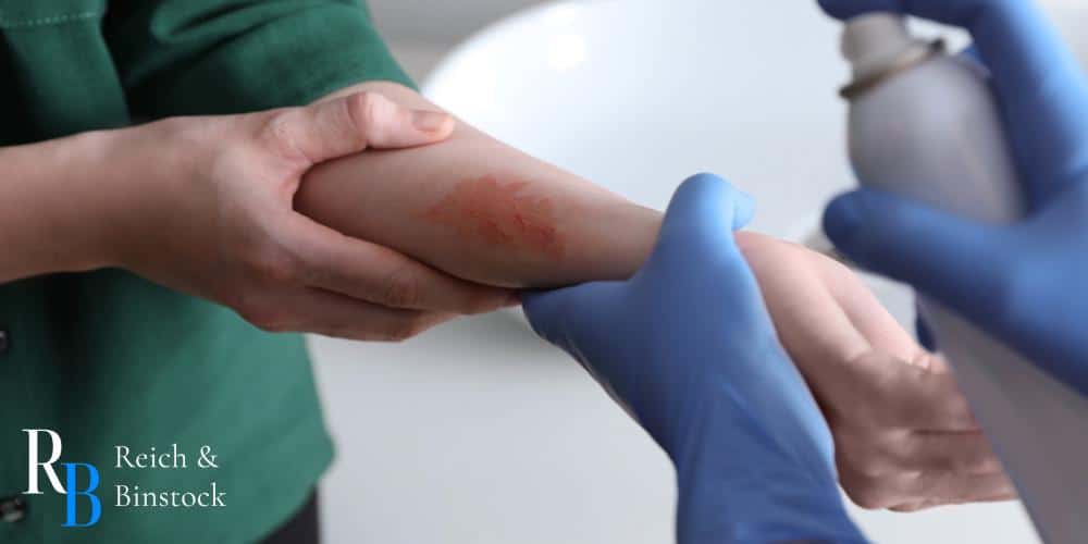 burn injury attorneys houston