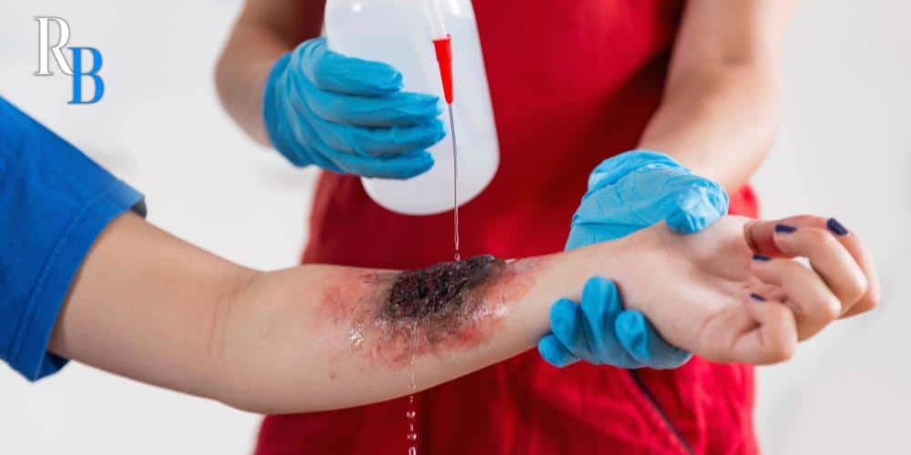 burn injury lawyer houston